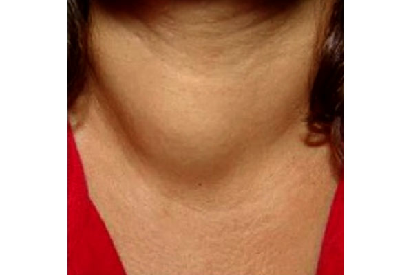 Thyroid Tumors