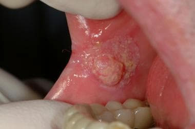 Buccal Mucosa Cancer