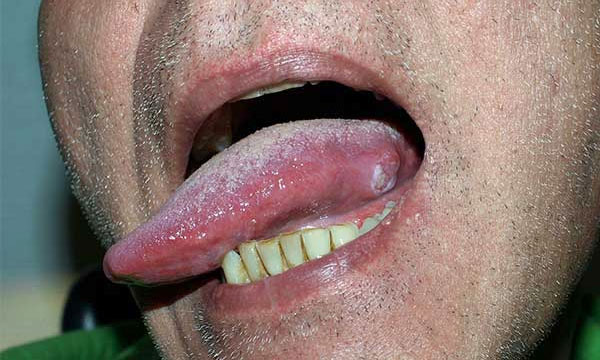 Tongue Cancer