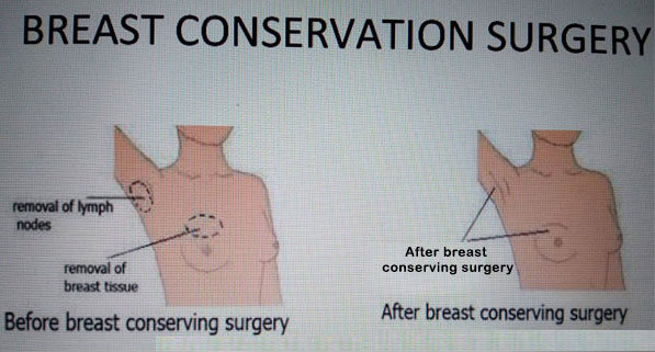 Breast Cancer