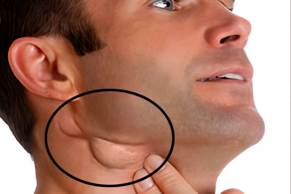 Neck Nodes