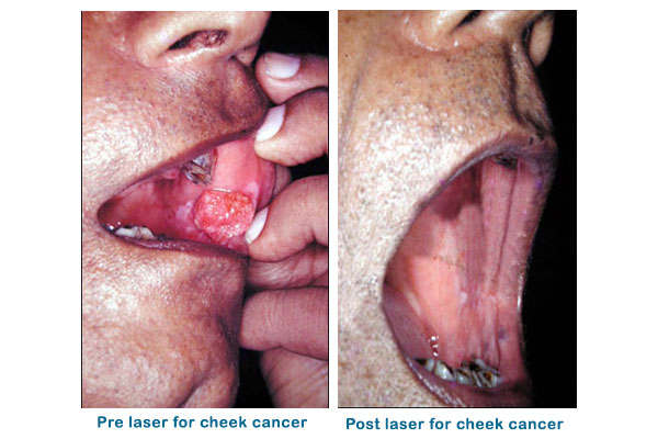 Oral Cancer