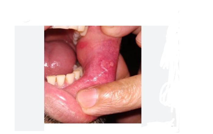 best buccal mucosa cancer surgeon in guwahati surat jalgaon siliguri